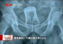 男子路边被迷晕 <em>肛门塞</em>玻璃杯(图)【1】-新闻频
