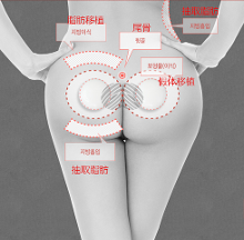 韩国流行丰臀术 打造女团翘臀