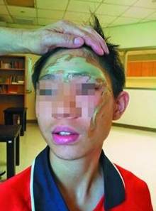 台北市内湖初中郑姓班导师误把浓硫酸当醋酸,一名女学生不慎把浓硫酸