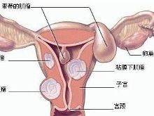 北京北科生殖医院治疗子宫肌瘤好方法?