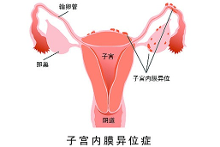 关于子宫内膜异位症相关性不孕患者腹腔镜术后生殖预后的影响因素的硕士论文范文