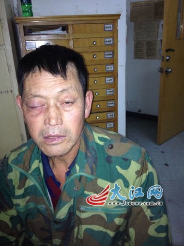 喝瓶饮料炸伤眼睛 爆炸时像手雷(组图)